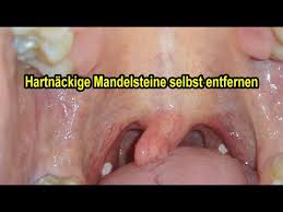 Der zug entfernte ihn mit großer geschwindigkeit von der heimat. Mandelsteine Selbst Entfernen Tonsillensteine Selber Absaugen Loswerden Anleitung Youtube