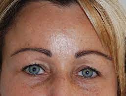 Das andere extreme zu obigem politiker. Augenbrauentransplantation Kostenlose Informationen Und Beratung Zu Augenbrauentransplantation Hairforlife