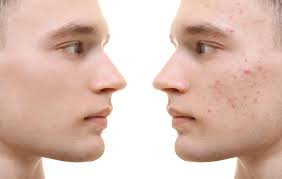 Face mapping verrät dir, was die position eines pickels über deine gesundheit aussagt Unreine Haut Ursachen Und Behandlung Heilpraxis