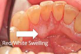 But the virus can cause changes in the mouth and throat making them more likely to become cancerous in the future. Mouth Cancer Atkinson Brignall Sevenoaks Kent