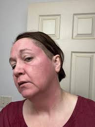 Newbie with rash after using face lotion