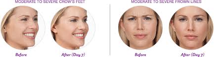 Botox® Injections in MN