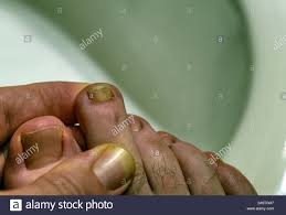Finger Und Zeh Stockfotos Und Bilder Kaufen Alamy