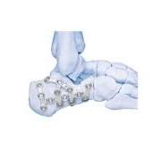 Locking Calcaneal Plates | Products | DePuy Synthes