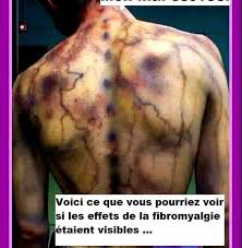 La fibromyalgie (fm) est une maladie qui affecterait le système nerveux central. Fibromyalgie Photos Facebook