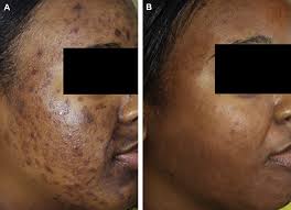 We did not find results for: Multimodal Treatment Of Acne Acne Scars And Pigmentation Dermatologic Clinics