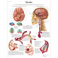 stroke chart