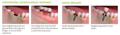 Plus, implants are popular because they give patients a natural, lasting smile, allowing them to live and eat without holding back. Straumann Tooth Replacement Solutions North Appleton Dentistry Llc Appleton Wi Dentist
