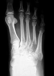 Ct scans are usually used to help form an initial bone cancer diagnosis and to see whether the cancer. Pathology Outlines Metastases