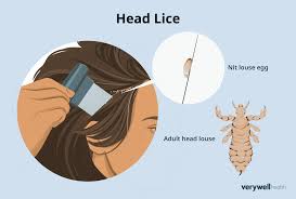 Image result for lice life cycle