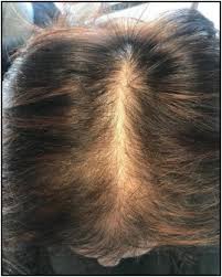 female pattern hair loss a clinical