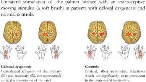 Cortical Lateralization Of Cheirosensory Processing In Callosal Dysgenesis Sciencedirect