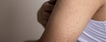 Image result for Keratosis pilaris