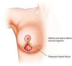 Breast Reduction In Lethbridge, Alberta | Lethbridge Plastic Surgery