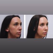 TOP 10 BEST Laser Skin Resurfacing near Madison, AL