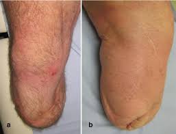 Today, lasers are used to treat hemorrhoids, pilonidal cysts, and a number of other conditions. Figure 2 From The Diverse Application Of Laser Hair Removal Therapy A Tertiary Laser Unit S Experience With Less Common Indications And A Literature Overview Semantic Scholar