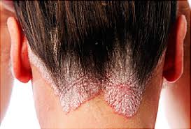 Where i was got new hairs that part is also start looking thinner. Scalp Psoriasis Causes Symptoms Treatment And Shampoos