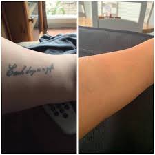 Laser tattoo removal is generally safe when performed by a qualified technician or doctor. Belleza Laser Tattoo Removal Home Facebook