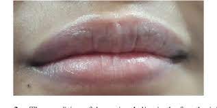 Pdf Allergic Contact Cheilitis Due To Lipstick Semantic Scholar