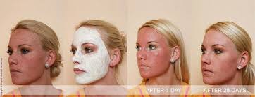 Chemical peel before and after. Chemical Peels Philadelphia Facial Skin Peels Pa