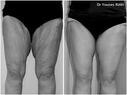 En pleine métamorphose culturelle, la chirurgie esthétique des seins trouve un succès grâce à ses réussites successives Dr Riah Chirurgie Esthetique Bastia Lifting Des Bras Des Cuisses