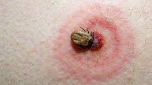 We did not find results for: How To Know When You Ve Been Bitten By A Tick Everyday Health