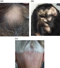 Efficacy and side effects including histologic study of the ensuing localized acneform response. Alopecia Areata A Review On Diagnosis Immunological Etiopathogenesis And Treatment Options Springerlink