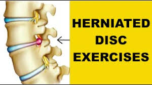 In some cases, untreated slipped discs can cut off the nerve impulses to. Best Exercises For Herniated Disc In Back Beat Sciatic Nerve Pain Youtube
