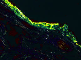 The dyeing of amyloid is by a mechanism similar to the direct textile dyeing of cotton. Lawren Is Openly Black On Twitter I Ll Take Apple Green Birefringence On Congo Red Staining For 400 Alex So Far We Have Only Learned Congo Red Staining With Reference To Amyloidosis Is It Regularly