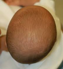 Image result for Positional Head Deformity