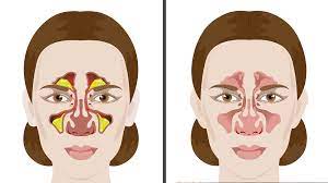 5 Easy Ways To Remove Mucus And Phlegm Naturally Cold Or Allergies Mucus Getting Rid Of Mucus