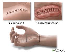 He trained as a steel worker before becoming a military pilot and in klushino in smolensk, his family home is now a museum. Gangrene Treatment In Chennai India Symptoms Of Gangrene