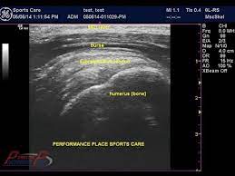How To Read Msk Ultrasound Of The Shoulder Youtube