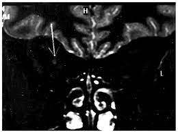 Lyme Disease Mri Appearance Of Right Optic Nerve Enhancement After Download Scientific Diagram