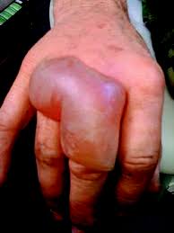 Noun a dry scab or slough formed on the skin as a result of a burn or by the action of a corrosive or caustic substance. Full Thickness Burn Definition Of Full Thickness Burn By Medical Dictionary