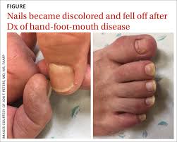 Image result for Onycholysis feet
