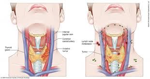 This is a type of lymph node in the inguinal region found in the upper inner thigh near the pelvis. Thyroid Cancer Stages Cancer Net