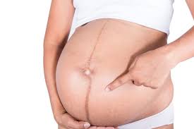 Sebagian besar tidak memiliki penyebab yang serius. Kenali Linea Nigra Garis Samar Yang Ada Di Perut Perempuan Halaman All Kompas Com
