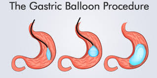 gastric balloon procedure