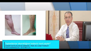 Prof Dr Cuneyt Koksoy Toplardamar Tikanikliginin Tedavisi Nasil Yapilir Youtube
