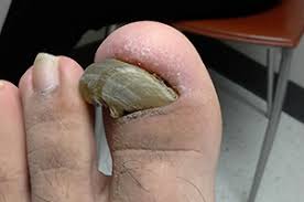 Most toenail fungus treatments take too long to work! Toenail Fungus Advanced Foot Ankle Care Specialists