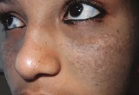 Image result for Diffuse Hyperpigmentation