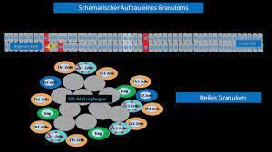 Granulom Altmeyers Enzyklopadie Fachbereich Dermatologie
