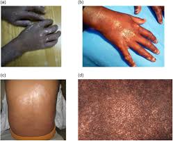 Image result for Systemic Sclerosis