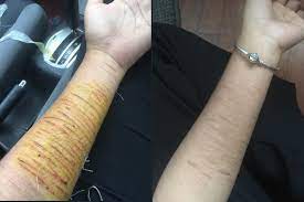 Haa satu hari tu kami gaduh. Ramai Pernah Kelar Tangan Hukum Diri Gadis Nasihat Mangsa Depresi Kalau Nak Baik Buat Rawatan Viral Mstar