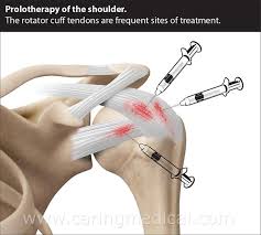 Shoulder Prolotherapy Rotator Cuff Shoulder Arthroscopy Rotator Cuff Tear