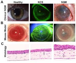 These changes don't signify a specific disease, but rather usually represent the body's response to stress or irritation. Keratoconjunctivitis Sicca Kcs And Squamous Metaplasia Sqm Of The Download Scientific Diagram