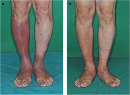 Image result for Lipodermatosclerosis