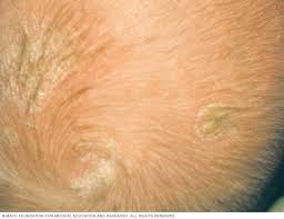 Image result for Cradle Cap