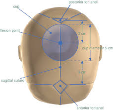 Image result for Vacuum Caput